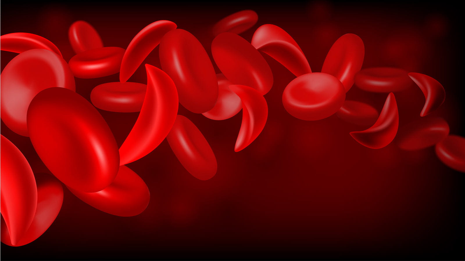 Examining the Role of Iron in Sickle Cell Disease